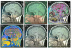 Imagen ictus