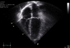 Igamen de Wikicommons Ecocardiografía