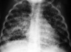 Radiografía de los pulmones